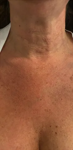 Aplicación del tratamiento de cuello