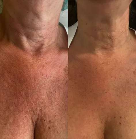 Tratamiento de cuello - Regeneración e hidratación